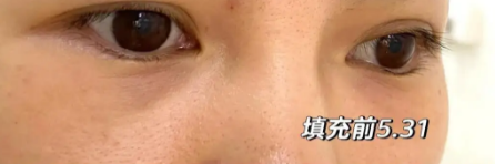 泪沟填充