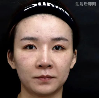 去眼袋手术