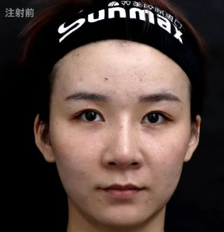 去眼袋手术