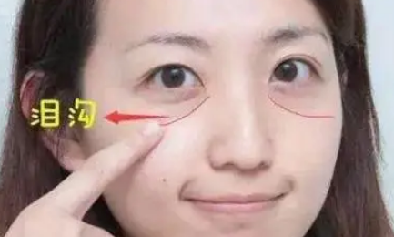 去眼袋手术