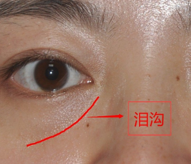 去眼袋手术