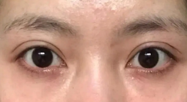 去眼袋手术