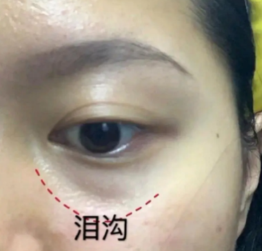 去眼袋手术