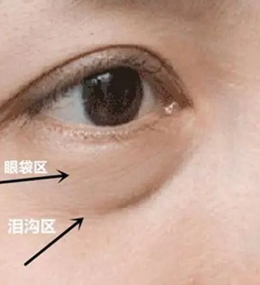 去眼袋手术