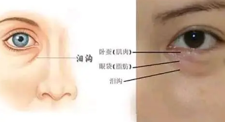 去眼袋手术