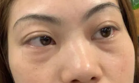 去眼袋手术