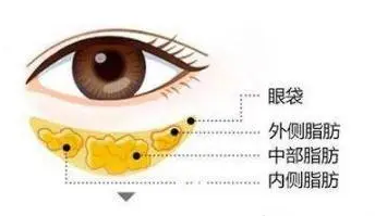 去眼袋手术