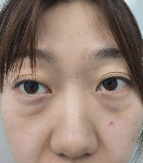 去眼袋手术