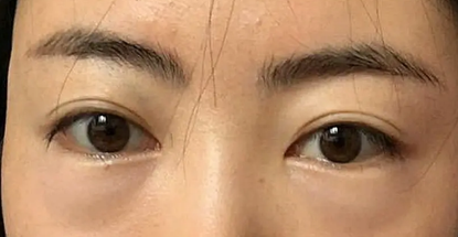 去眼袋手术