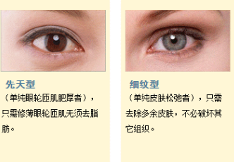 去眼袋手术