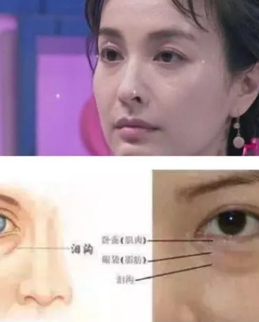眼袋