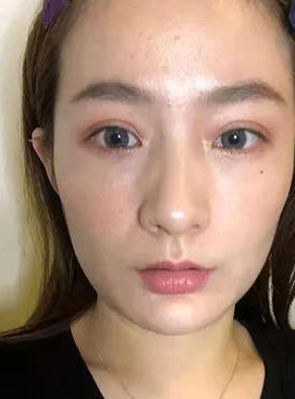 眼袋
