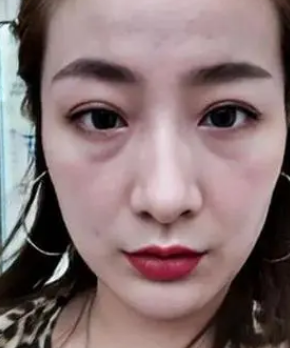 眼袋