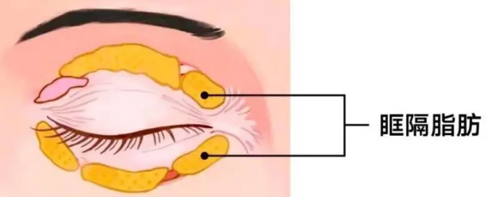 去眼袋手术
