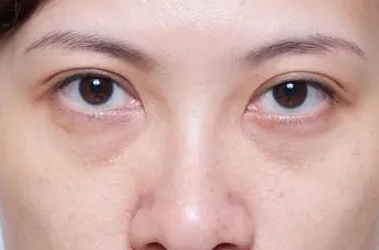 眼袋