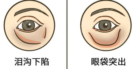 去眼袋手术