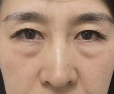 去眼袋手术