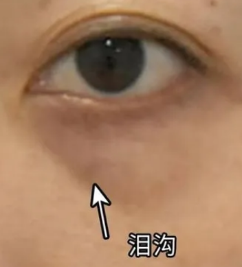 泪沟填充