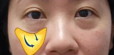 泪沟填充
