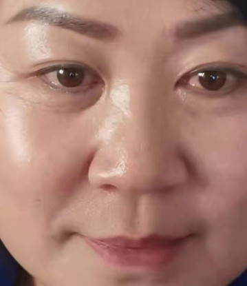 去眼袋手术