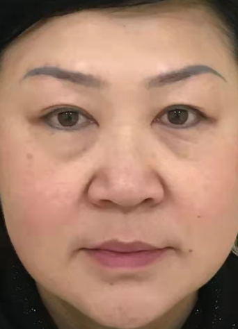 去眼袋手术