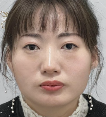 去眼袋手术