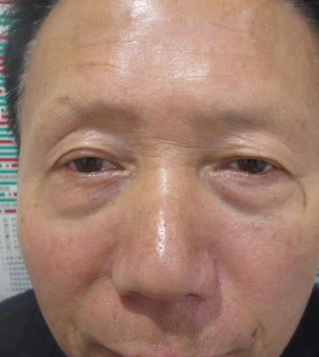 去眼袋手术