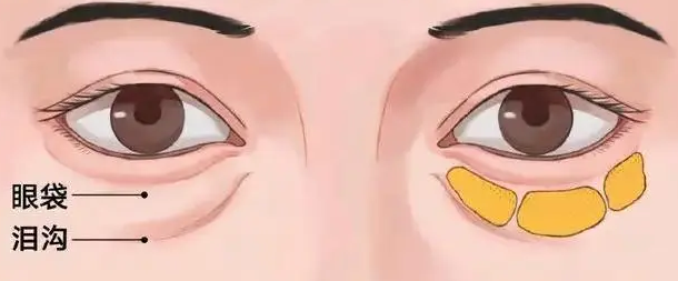 去眼袋手术