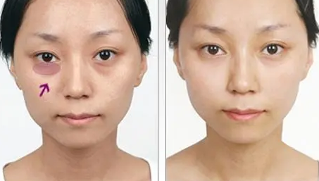去眼袋手术