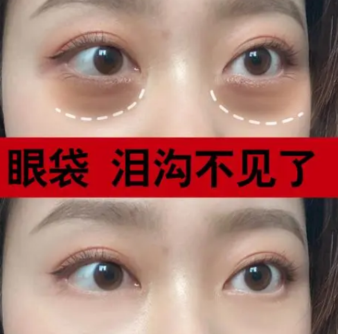 泪沟填充