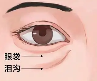 泪沟填充