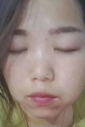 雀斑