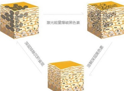 雀斑