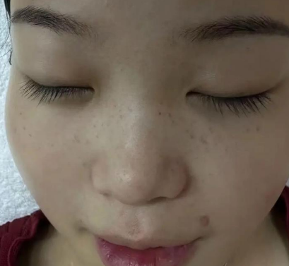 雀斑