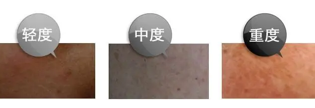 雀斑