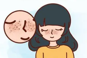 雀斑