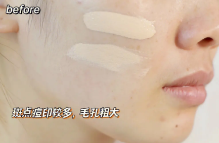 雀斑