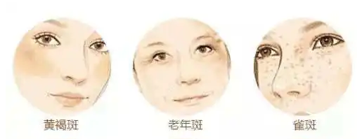 黄褐斑