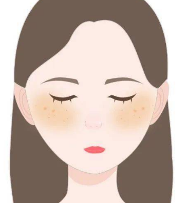 黄褐斑