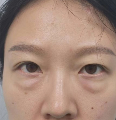 眼袋