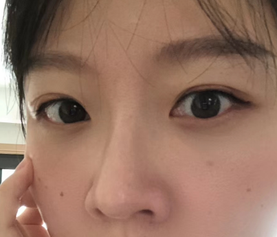 眼袋