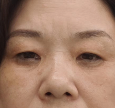 眼袋