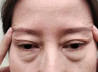 眼袋