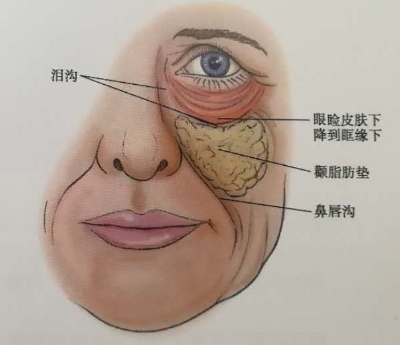 眼袋手术