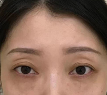 眼袋手术