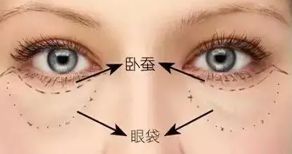眼袋手术