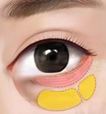 眼袋手术