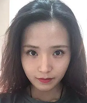 自体脂肪填充