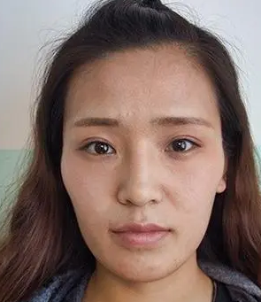 自体脂肪填充