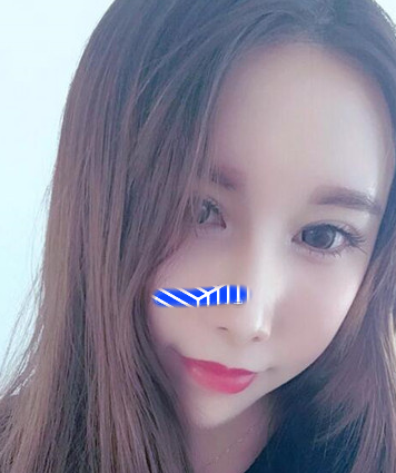 自体脂肪填充